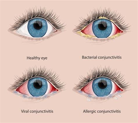 conjunctivitis pink eye causes and real treatments nvision eye centers