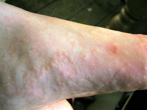 Dyshidrotic Eczema Pictures Natural Treatment Symptoms Causes