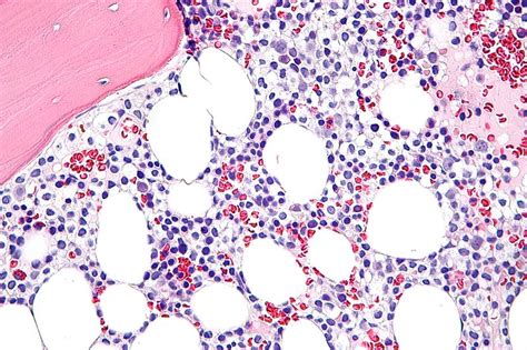 Hairy Cell Leukemia Pathophysiology Wikidoc
