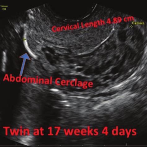 Intraoperative Ultrasound Picture Showing The Cervix With Cerclage In Download Scientific