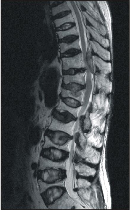 Figure 1 From Epidural Hematoma After Epidural Catheterization Without