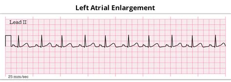 What You Must Know About Left Atrial Enlargement
