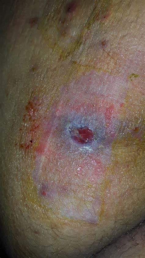What is the treatment for mrsa infections? MRSA: Treating it naturally: My journey with MRSA / Cellulitis