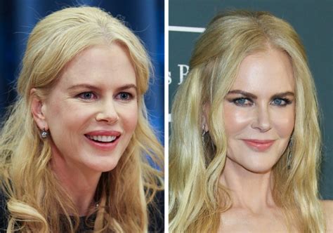 Nicole Kidman Et La Chirurgie Esthétique - Ces stars qui assument d'avoir eu recours à la chirurgie esthétique