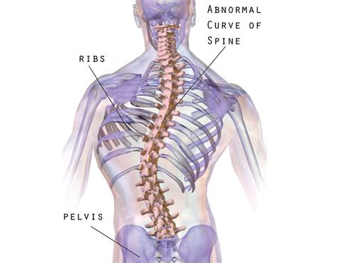 Scoliosis in adults what to know about symptoms treatment. Scoliosis muscular imbalance - Why does scoliosis create ...