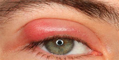 How to get rid of a pimple in my earlobe. Pimples on Eyelids