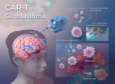 Phase I Clinical Trial Using Car T For Glioblastoma To Begin At Unc
