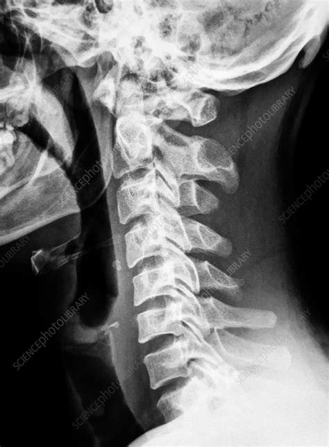 Normal Cervical Spine X Ray Stock Image C0393923 Science Photo