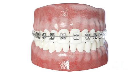 Dental Braces Photograph By Sebastian Kaulitzki Science Photo Library Fine Art America