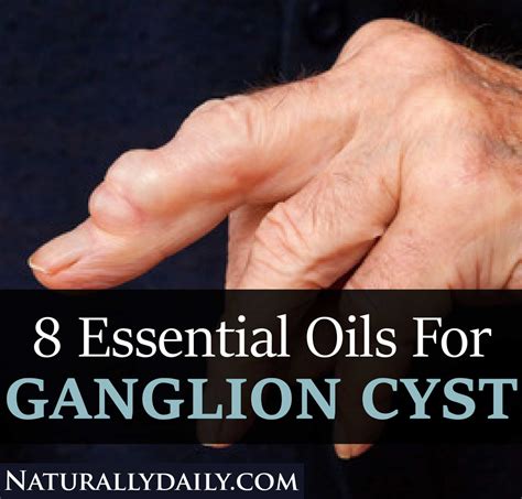 8 Essential Oils For Ganglion Cyst And How To Use Them