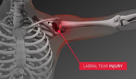 Labral Tear Slap Tear Shoulder Injuries Sterling Medical Group