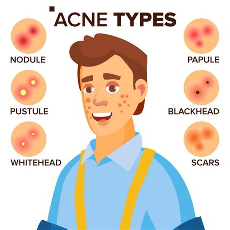Acne Types Vector Man With Acne Facial Skin Problems Papule