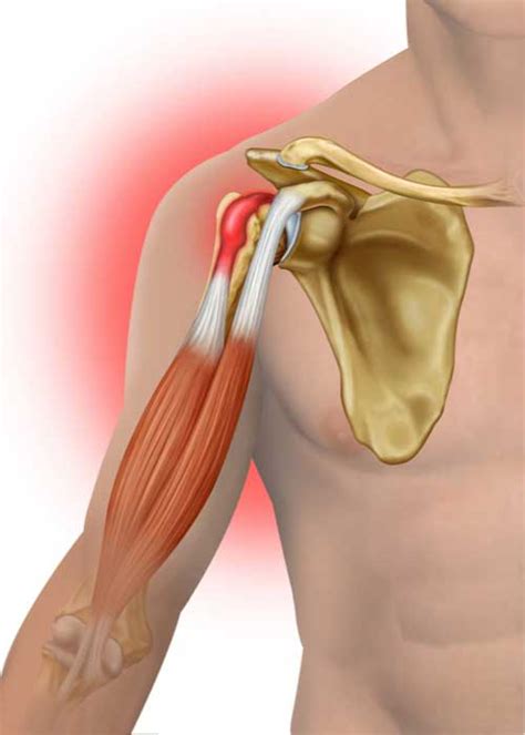 Biceps Tendon Tear Orthopedic Shoulder Specialist Manhattan New York City And New York