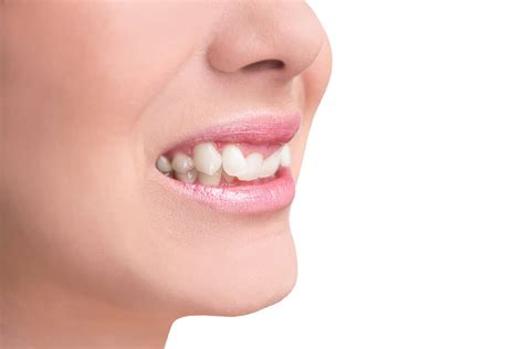 Your Overbite Guide Causes And Treatment Methods Absolute Dental