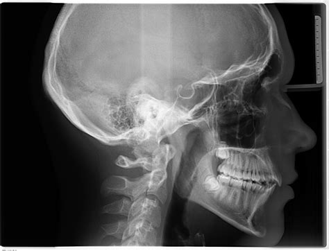 Telerradiografía Lateral De Cráneo Radiografia De Craneo