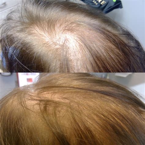 Hair loss treatments available to patients get better and better as time goes on. Hair Restoration - Natural Hair Growth | Altaire Clinic