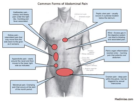 Abdominal Pain Stomach Ache Causes And Treatments Medimise