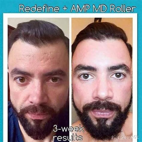 Before And After Derma Roller Beard Cortezleong
