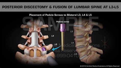 Posterior Discectomy And Fusion Of Lumbar Spine At L3 L5 Youtube