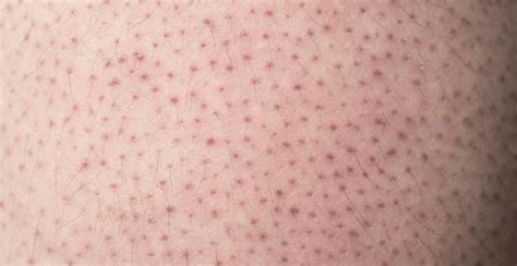 What Is Strawberry Skin And How To Treat It Clinikally