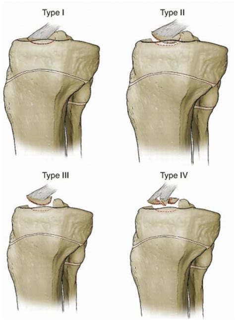 Tibial spine fractures are more common in the pediatric population. Arthroscopy-Assisted Management or Open Reduction and ...