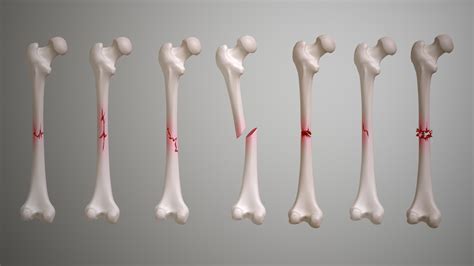 fractures types symptoms causes and treatment scientific animations