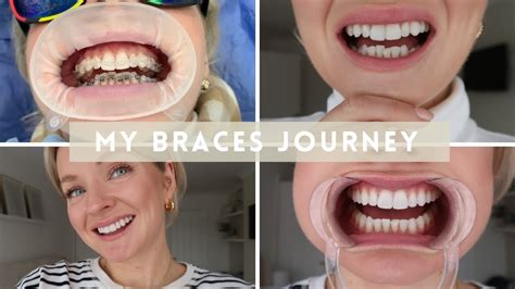 My Adult Braces Journey Teeth Transformation Wearing Fixed Ceramic