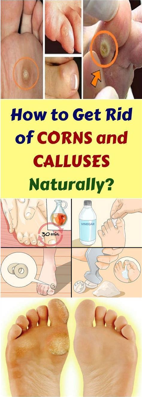 How To Get Rid Of Corns And Calluses Naturally All What You Need Is Here Get Rid Of Corns