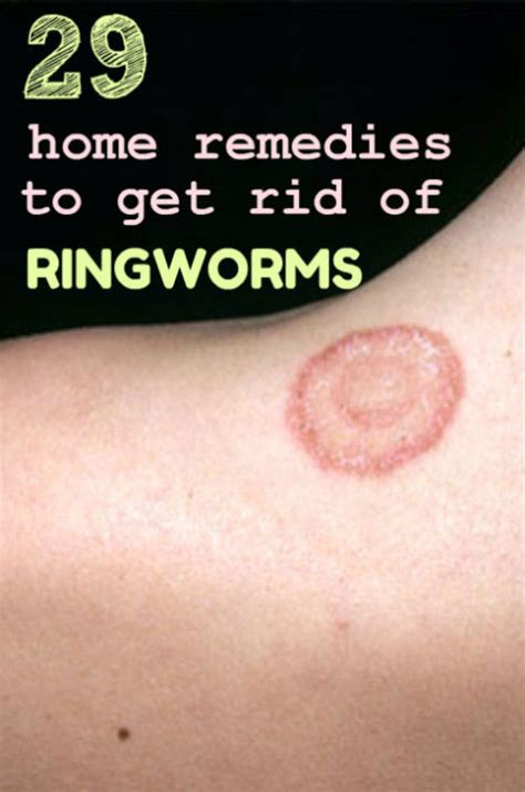 Home Remedy Hacks • 29 Home Remedies To Get Rid Of Ringworm Fast