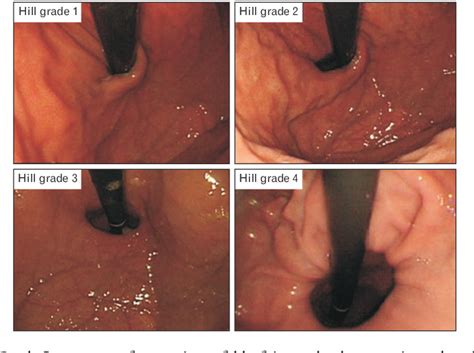 Figure 1 From Usefulness Of Endoscopic Hill Grade In Evaluating