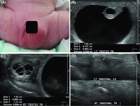 Indirect Inguinal Hernia Ultrasound
