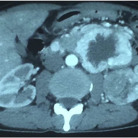 Abdominal Ct Scan Showing A Left Renal Lesion Of 11 Cm Isodense With