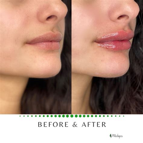 Lip Augmentation Before And After Lip Augmentation Aesthetic