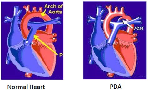 Patent Ductus Arteriosus Pda Treatments Singhealth