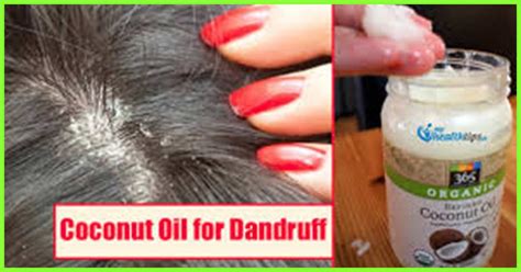 Coconut oil is the holy grail of haircare: How To Use Coconut Oil For Dandruff | Coconut oil for ...