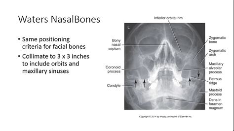 Closed loop in small bowel obstruction. Nasal Bone Ct Scan Anatomy - ct scan machine
