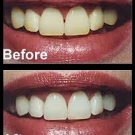 Baking Soda Peroxide Toothpaste Whitening Recipe Besto Blog