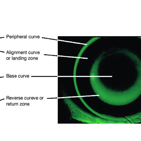 A Radial Keratotomy Scars On The Human Eye B Epikeratophakia Download Scientific Diagram