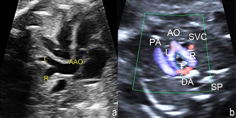 Fetal Double Aortic Arch Prenatal Sonographic And Postnatal Computed