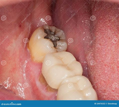Macro Image Of Filled Teeth Stock Photo Image Of Caries Closeup