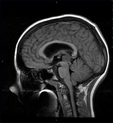 Pineal Tumor Pineocytoma Neuro Mr Case Studies Ctisus Ct Scanning