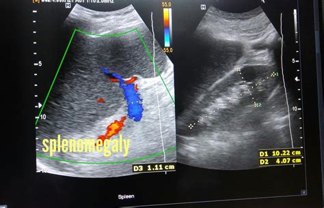 Ultrasound Imaging Nodular Cirrhosis Liver