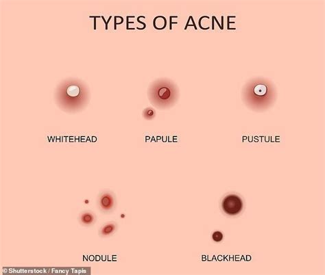 Revealed The Six Types Of Pimple And The Best Way To Treat Each One