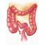 Treatment Of Colon Or Rectal Cancer