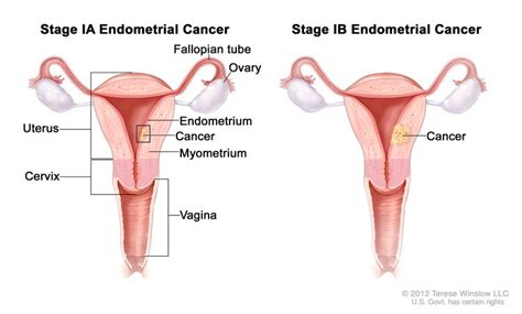 Endometrial Cancer Treatment Pdq®patient Version National Cancer