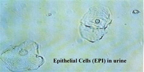 Everything You Need To Know About Epithelial Cells In Urine
