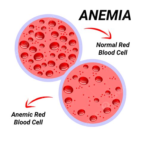 Anemia Png Vector Psd And Clipart With Transparent Background For