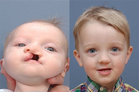 Cleft Lip Correction Before And After Photos Ernesto J Ruas Md