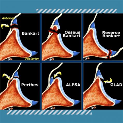 Types Of Labral Tears Ashvin K Dewan Md