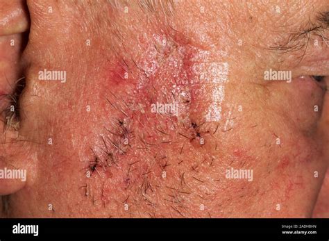 Skin Cancer Scar Image 2 Of 3 Scar On The Head Of An 84 Year Old Man